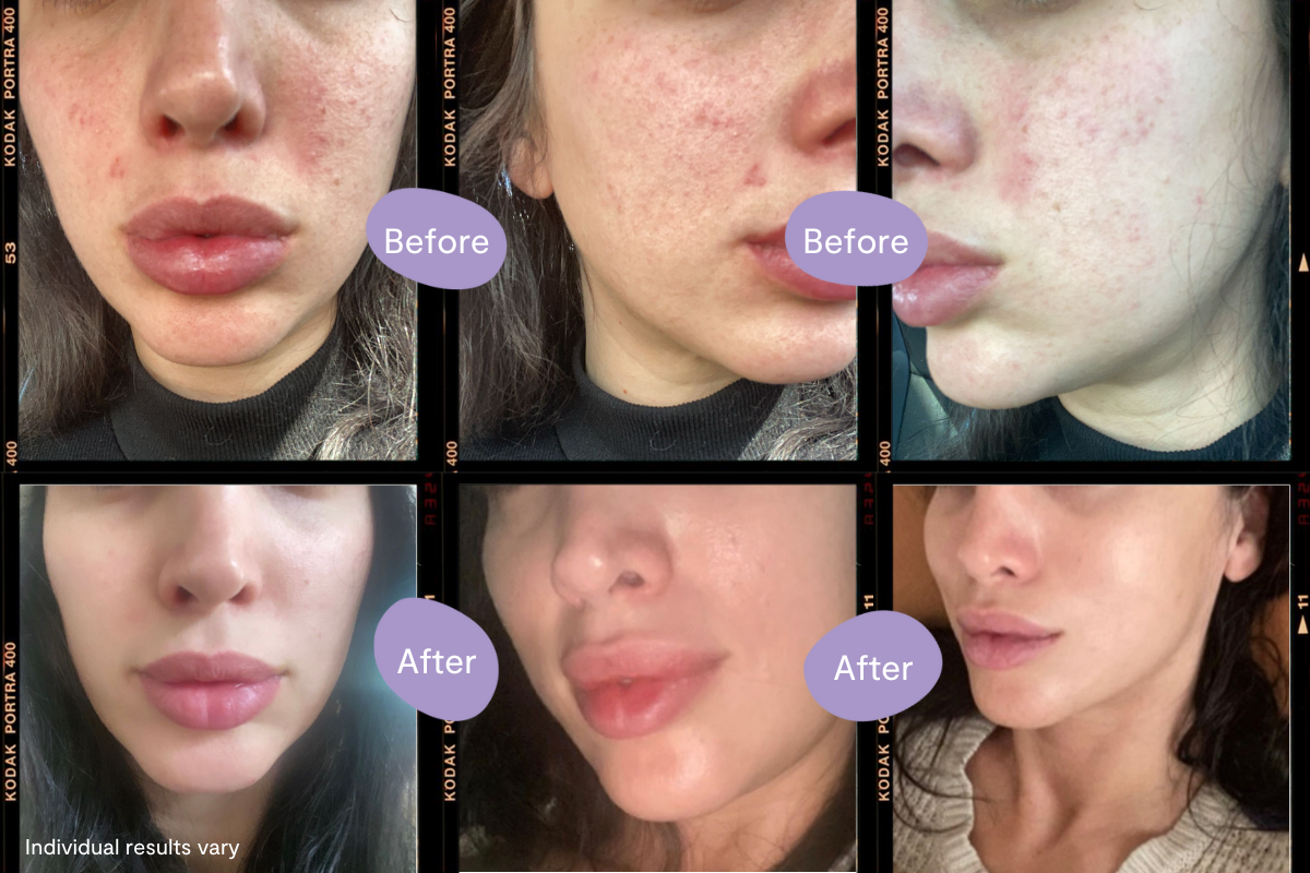 Before & After: Chrissy’s Skincare Journey